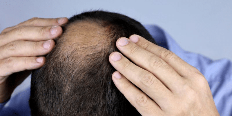 Hair Loss on Steroids: Causes, Prevention, and UK Treatments